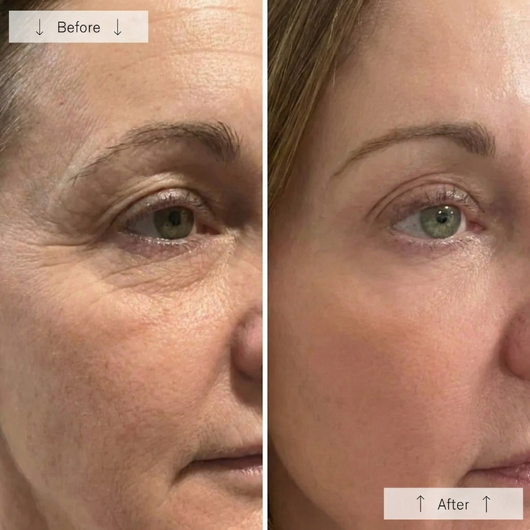 Livali Red Light Therapy Mask