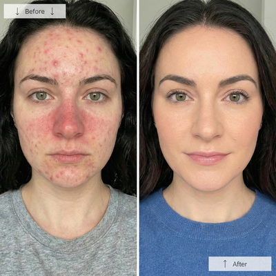 Livali Red Light Therapy Mask